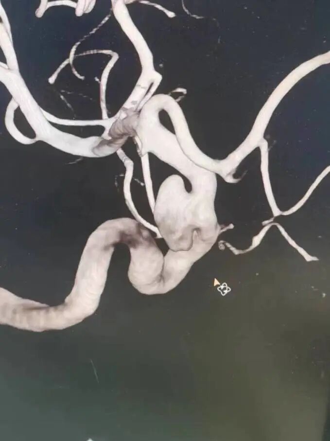 动脉长鞘怎么置入术说·第十七期丨Infinity长鞘助力Surpass Streamline血流导向密网支架治疗双侧颈内迂曲路径动脉瘤一例_https://www.jmylbn.com_新闻资讯_第10张