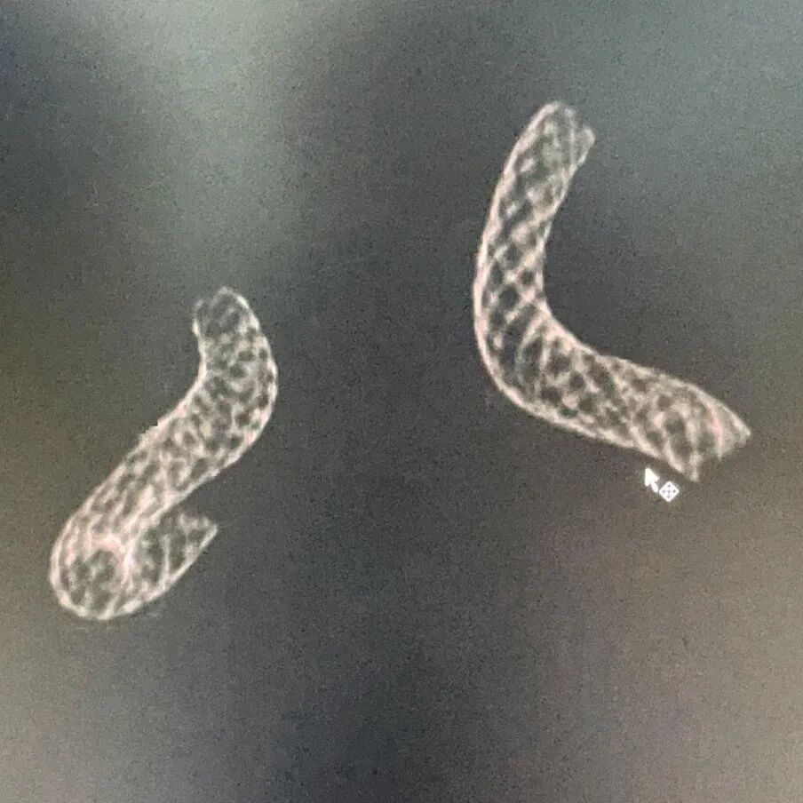 动脉长鞘怎么置入术说·第十七期丨Infinity长鞘助力Surpass Streamline血流导向密网支架治疗双侧颈内迂曲路径动脉瘤一例_https://www.jmylbn.com_新闻资讯_第32张