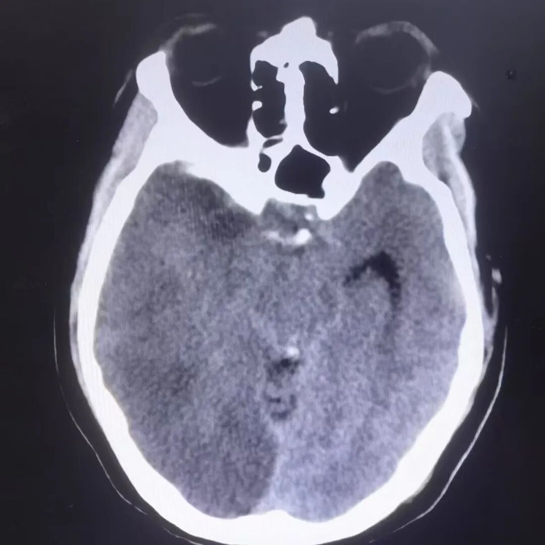 动脉长鞘怎么置入有励可说｜Locaste 088励楷长鞘在右侧颈内动脉闭塞并夹层术中的应用_https://www.jmylbn.com_新闻资讯_第19张