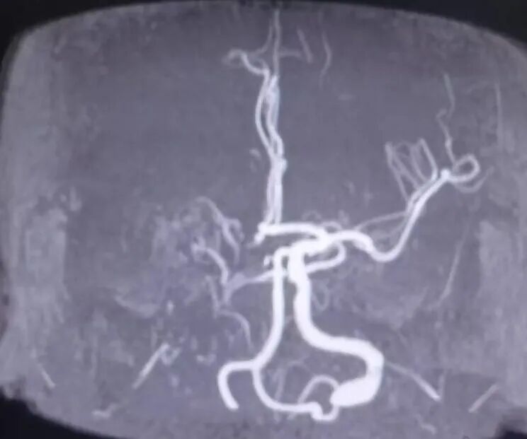 动脉长鞘怎么置入有励可说｜Locaste 088励楷长鞘在右侧颈内动脉闭塞并夹层术中的应用_https://www.jmylbn.com_新闻资讯_第4张