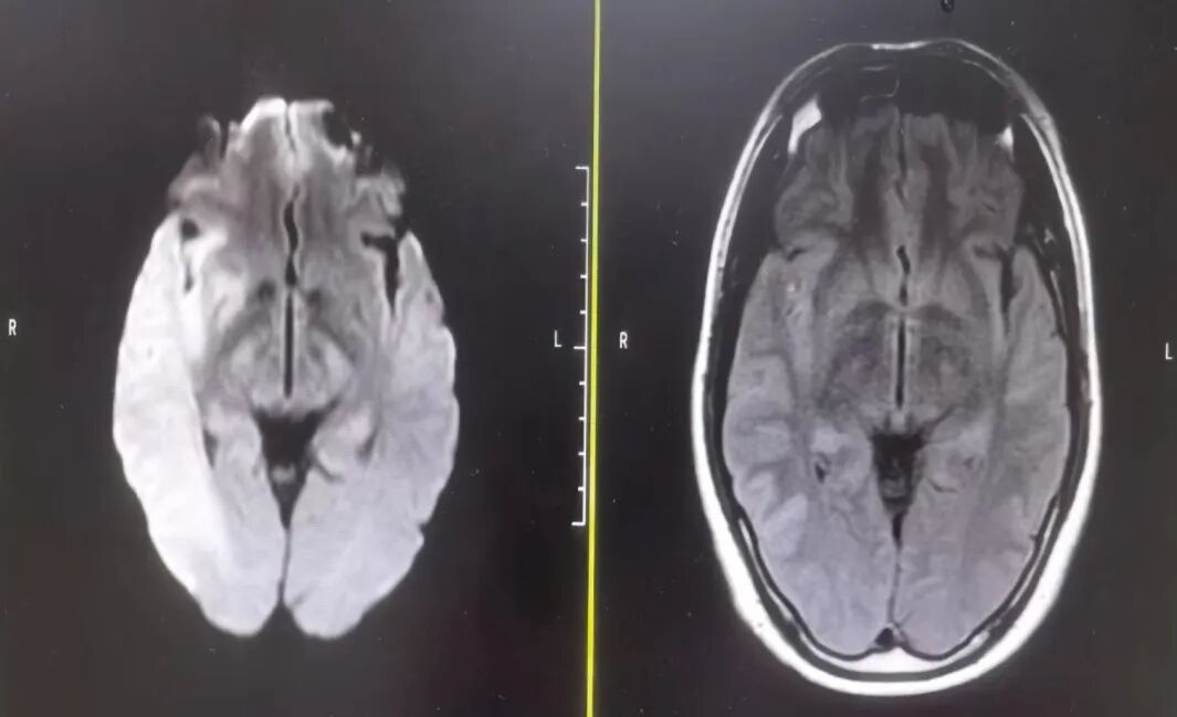 动脉长鞘怎么置入有励可说｜Locaste 088励楷长鞘在右侧颈内动脉闭塞并夹层术中的应用_https://www.jmylbn.com_新闻资讯_第5张