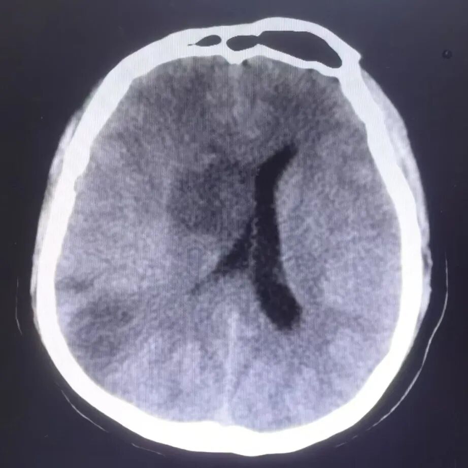 动脉长鞘怎么置入有励可说｜Locaste 088励楷长鞘在右侧颈内动脉闭塞并夹层术中的应用_https://www.jmylbn.com_新闻资讯_第18张