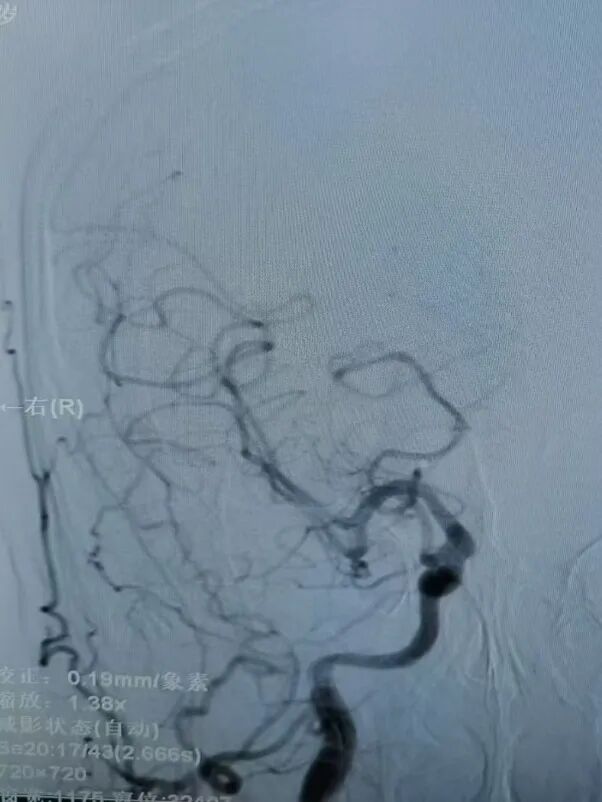 动脉长鞘怎么置入有励可说｜Locaste 088励楷长鞘在右侧颈内动脉闭塞并夹层术中的应用_https://www.jmylbn.com_新闻资讯_第16张