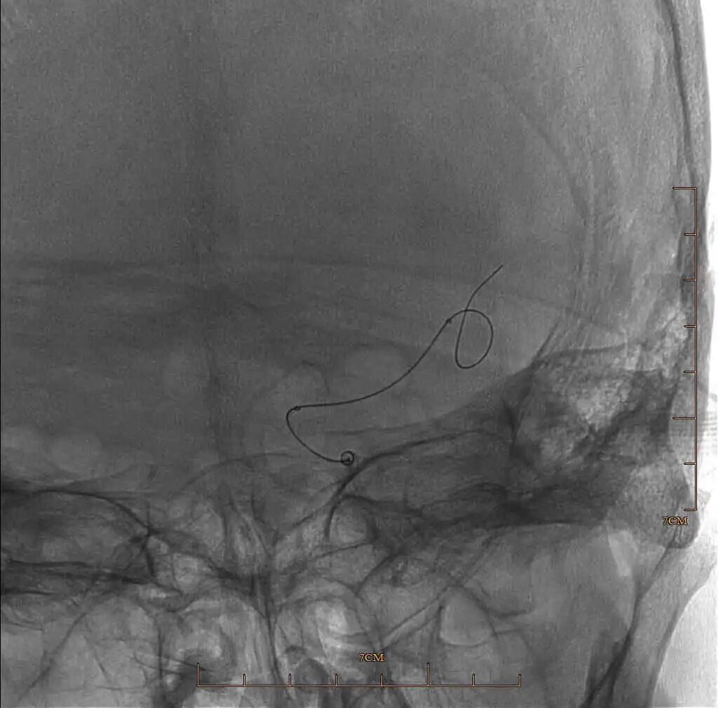 动脉长鞘怎么置入有励可说｜Locaste 088励楷长鞘及Tarvos微导丝在左侧大脑中动脉闭塞取栓术中的应用_https://www.jmylbn.com_新闻资讯_第15张