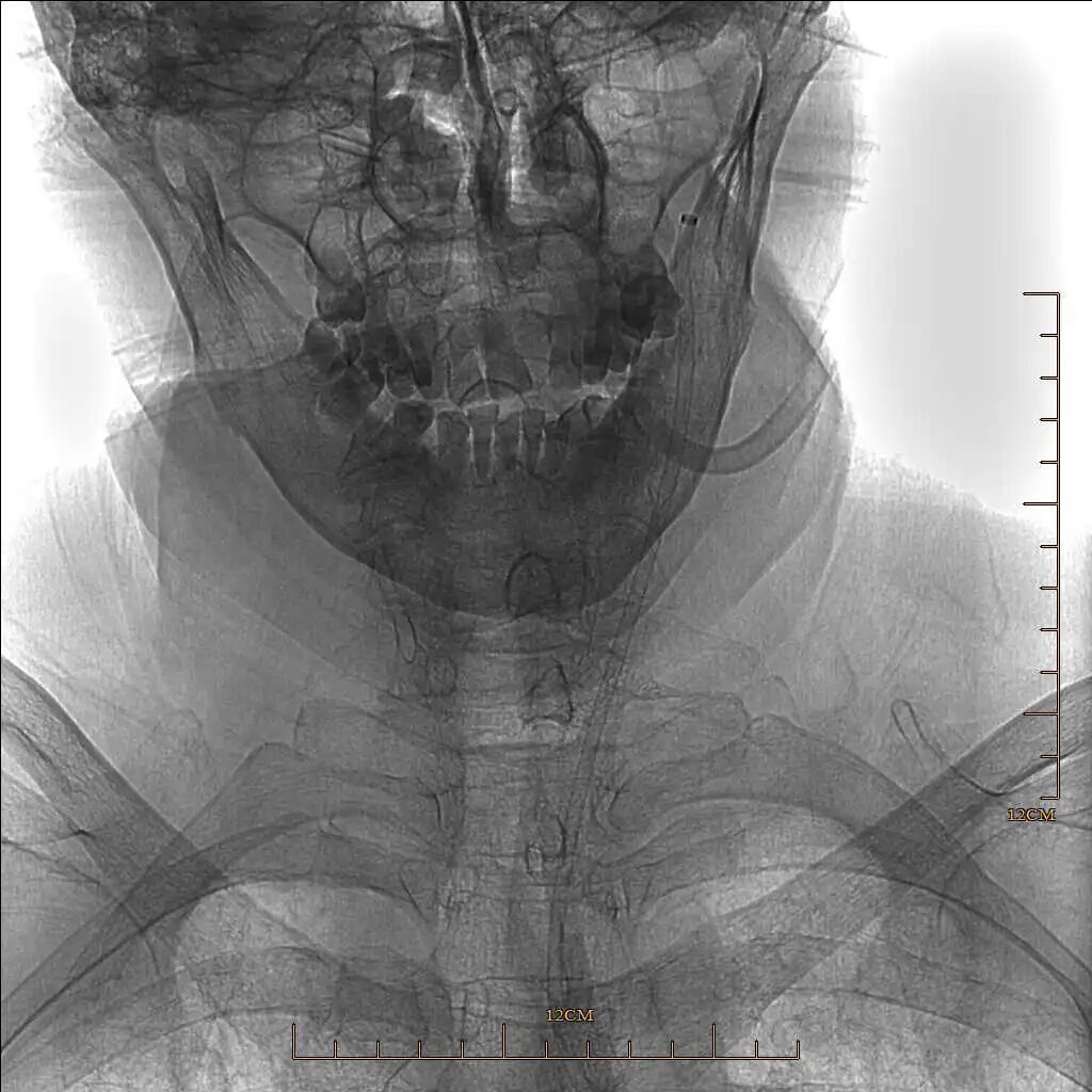 动脉长鞘怎么置入有励可说｜Locaste 088励楷长鞘及Tarvos微导丝在左侧大脑中动脉闭塞取栓术中的应用_https://www.jmylbn.com_新闻资讯_第8张