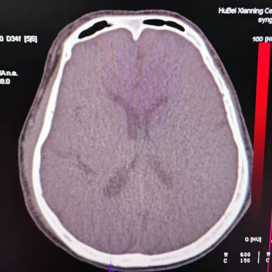 动脉长鞘怎么置入有励可说｜Locaste 088励楷长鞘及Tarvos微导丝在左侧大脑中动脉闭塞取栓术中的应用_https://www.jmylbn.com_新闻资讯_第25张
