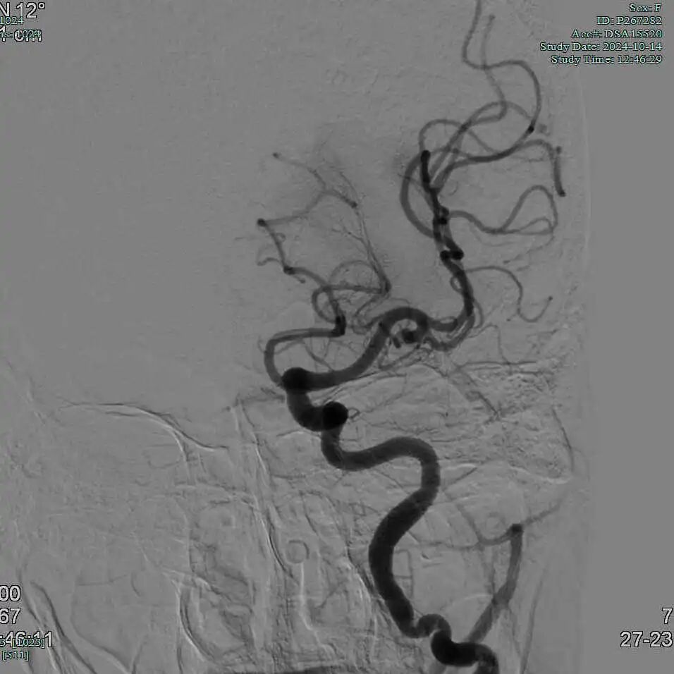 动脉长鞘怎么置入有励可说｜Locaste 088励楷长鞘及Tarvos微导丝在左侧大脑中动脉闭塞取栓术中的应用_https://www.jmylbn.com_新闻资讯_第13张