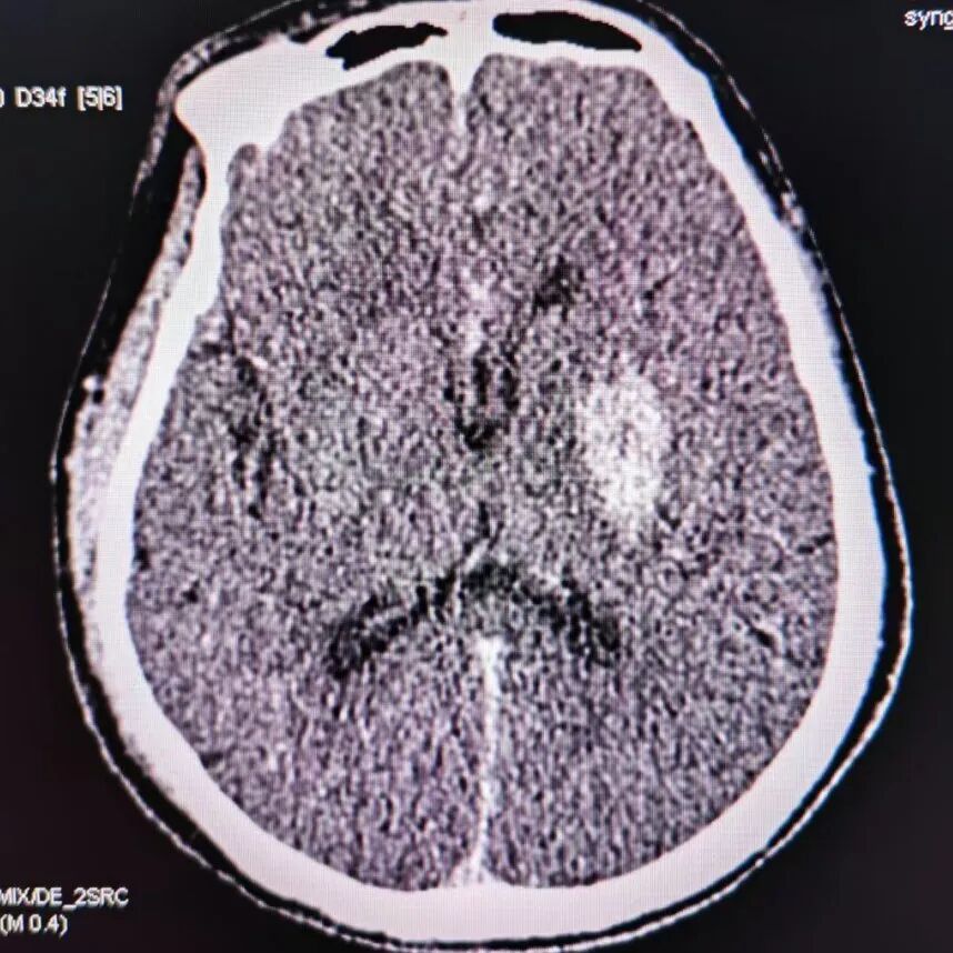 动脉长鞘怎么置入有励可说｜Locaste 088励楷长鞘及Tarvos微导丝在左侧大脑中动脉闭塞取栓术中的应用_https://www.jmylbn.com_新闻资讯_第23张