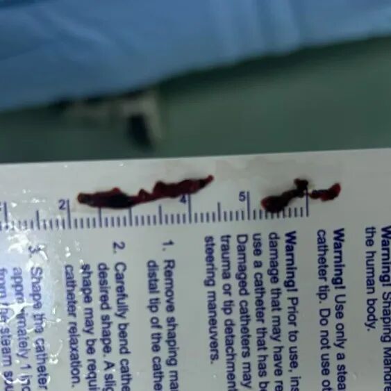 动脉长鞘怎么置入有励可说｜Locaste 088励楷长鞘及Tarvos微导丝在左侧大脑中动脉闭塞取栓术中的应用_https://www.jmylbn.com_新闻资讯_第21张