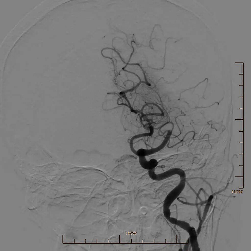 动脉长鞘怎么置入有励可说｜Locaste 088励楷长鞘及Tarvos微导丝在左侧大脑中动脉闭塞取栓术中的应用_https://www.jmylbn.com_新闻资讯_第9张