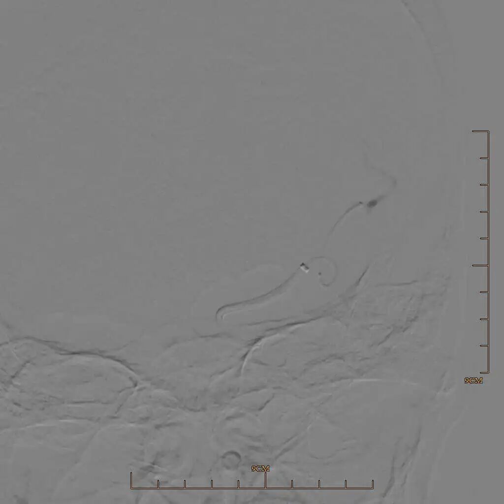 动脉长鞘怎么置入有励可说｜Locaste 088励楷长鞘及Tarvos微导丝在左侧大脑中动脉闭塞取栓术中的应用_https://www.jmylbn.com_新闻资讯_第16张