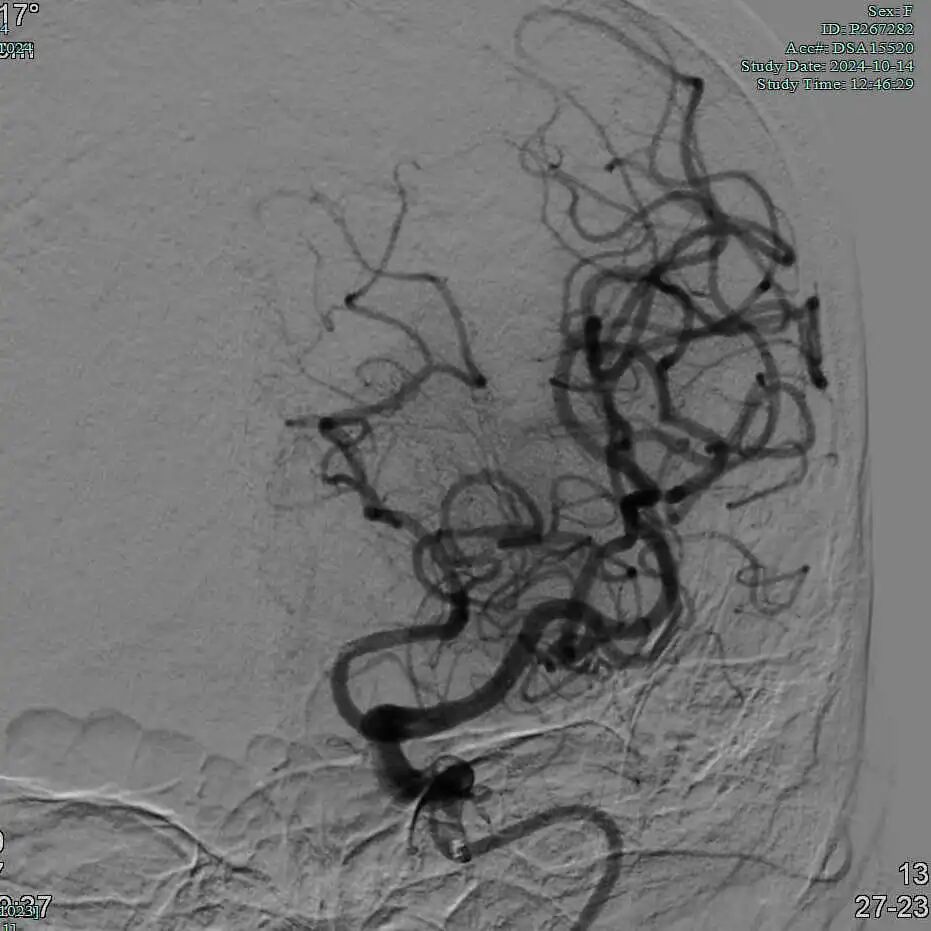 动脉长鞘怎么置入有励可说｜Locaste 088励楷长鞘及Tarvos微导丝在左侧大脑中动脉闭塞取栓术中的应用_https://www.jmylbn.com_新闻资讯_第18张