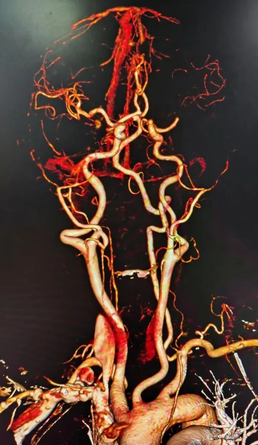 动脉长鞘怎么置入有励可说｜Locaste 088励楷长鞘及Tarvos微导丝在左侧大脑中动脉闭塞取栓术中的应用_https://www.jmylbn.com_新闻资讯_第5张