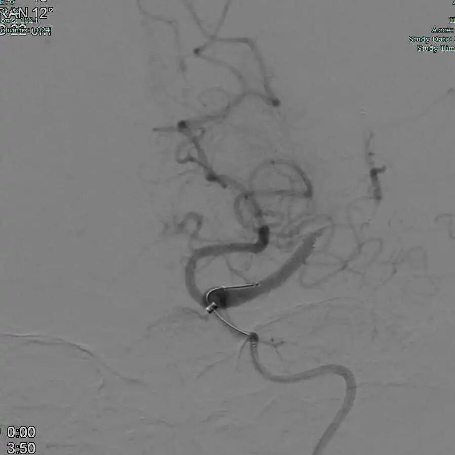 动脉长鞘怎么置入有励可说｜Locaste 088励楷长鞘及Tarvos微导丝在左侧大脑中动脉闭塞取栓术中的应用_https://www.jmylbn.com_新闻资讯_第12张