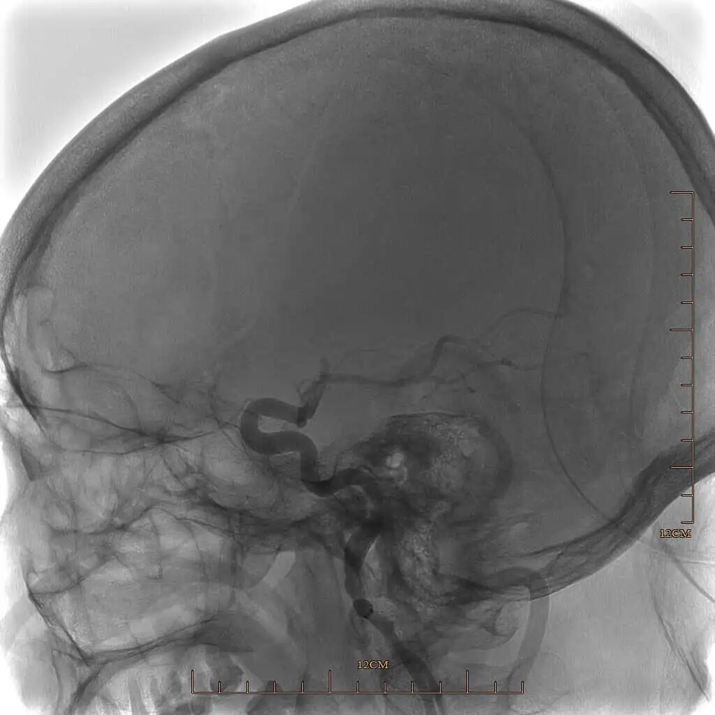 动脉长鞘怎么置入有励可说｜Locaste 088励楷长鞘及Tarvos微导丝在左侧大脑中动脉闭塞取栓术中的应用_https://www.jmylbn.com_新闻资讯_第10张