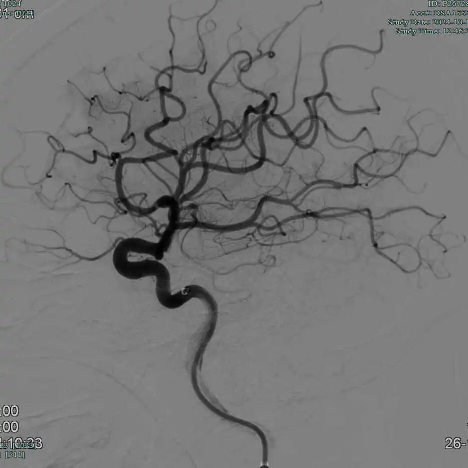 动脉长鞘怎么置入有励可说｜Locaste 088励楷长鞘及Tarvos微导丝在左侧大脑中动脉闭塞取栓术中的应用_https://www.jmylbn.com_新闻资讯_第19张
