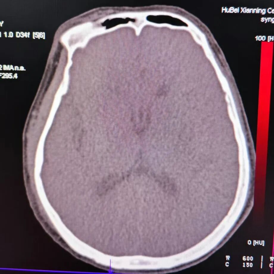 动脉长鞘怎么置入有励可说｜Locaste 088励楷长鞘及Tarvos微导丝在左侧大脑中动脉闭塞取栓术中的应用_https://www.jmylbn.com_新闻资讯_第24张