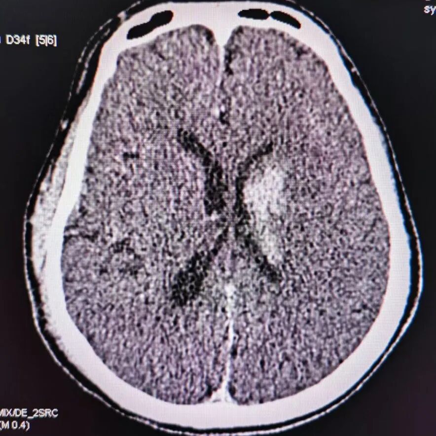 动脉长鞘怎么置入有励可说｜Locaste 088励楷长鞘及Tarvos微导丝在左侧大脑中动脉闭塞取栓术中的应用_https://www.jmylbn.com_新闻资讯_第22张