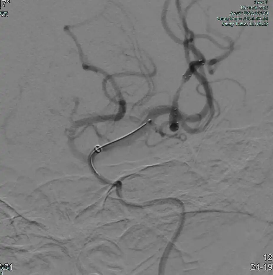 动脉长鞘怎么置入有励可说｜Locaste 088励楷长鞘及Tarvos微导丝在左侧大脑中动脉闭塞取栓术中的应用_https://www.jmylbn.com_新闻资讯_第17张