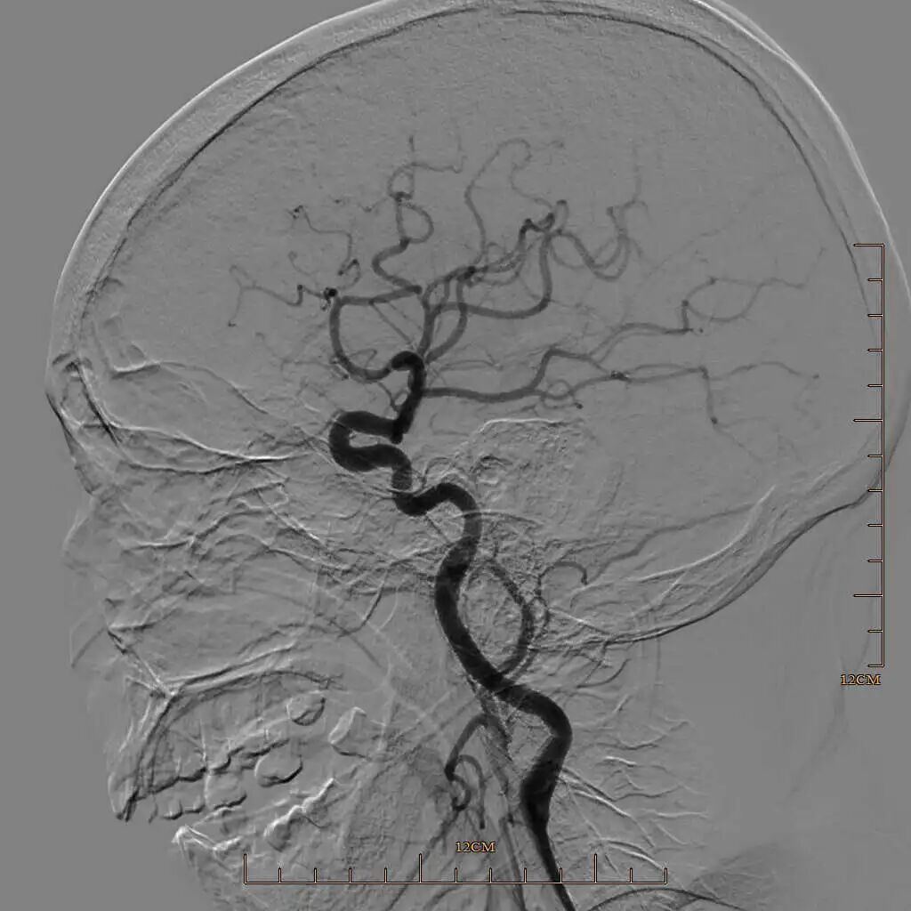 动脉长鞘怎么置入有励可说｜Locaste 088励楷长鞘及Tarvos微导丝在左侧大脑中动脉闭塞取栓术中的应用_https://www.jmylbn.com_新闻资讯_第20张