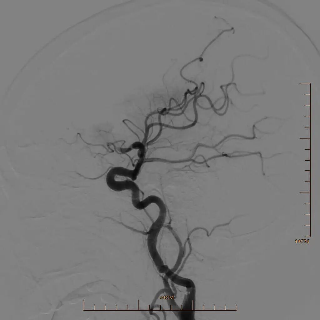 动脉长鞘怎么置入有励可说｜Locaste 088励楷长鞘及Tarvos微导丝在左侧大脑中动脉闭塞取栓术中的应用_https://www.jmylbn.com_新闻资讯_第14张