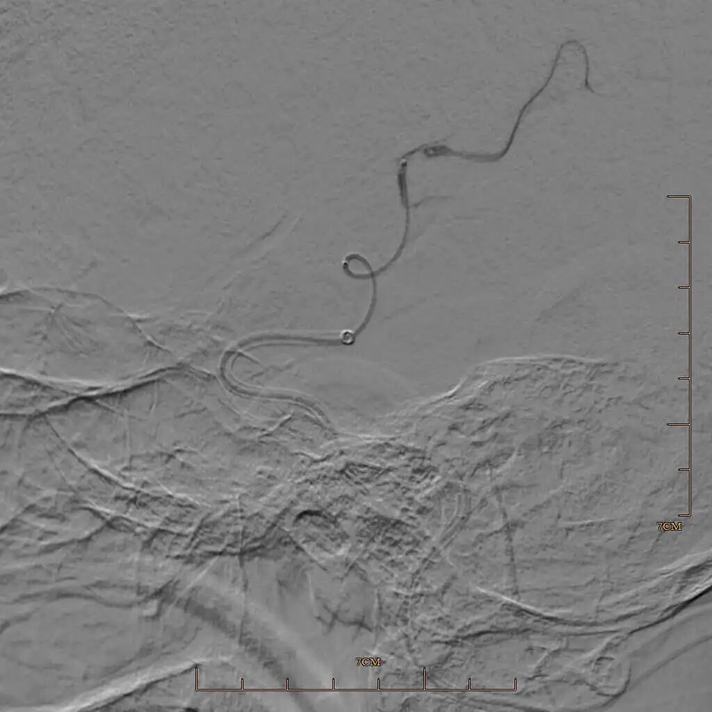 动脉长鞘怎么置入有励可说｜Locaste 088励楷长鞘及Tarvos微导丝在左侧大脑中动脉闭塞取栓术中的应用_https://www.jmylbn.com_新闻资讯_第11张