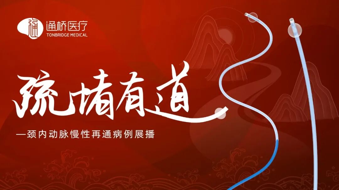 动脉长鞘怎么置入疏堵有道丨8F长鞘辅助BGC球囊导管大脑中动脉取栓术_https://www.jmylbn.com_新闻资讯_第2张