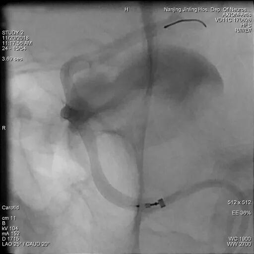 为什么要用到微导管张鑫教授：“球囊锚定微导管辅助到位”技术在Pipeline Flex治疗复杂动脉瘤手术中的应用_https://www.jmylbn.com_新闻资讯_第10张