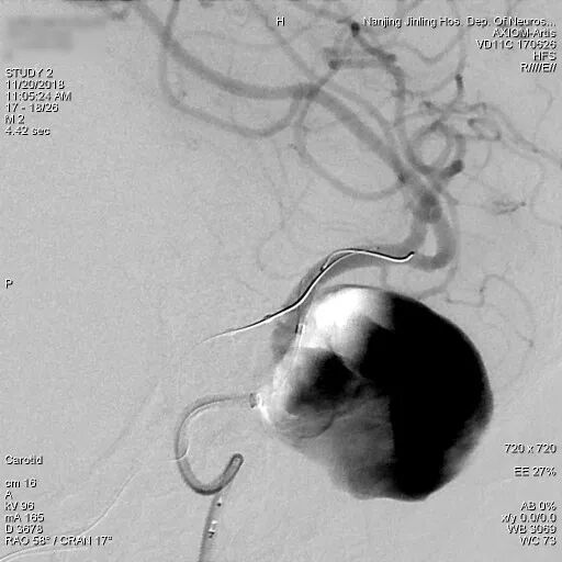 为什么要用到微导管张鑫教授：“球囊锚定微导管辅助到位”技术在Pipeline Flex治疗复杂动脉瘤手术中的应用_https://www.jmylbn.com_新闻资讯_第7张