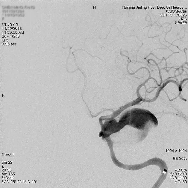 为什么要用到微导管张鑫教授：“球囊锚定微导管辅助到位”技术在Pipeline Flex治疗复杂动脉瘤手术中的应用_https://www.jmylbn.com_新闻资讯_第12张