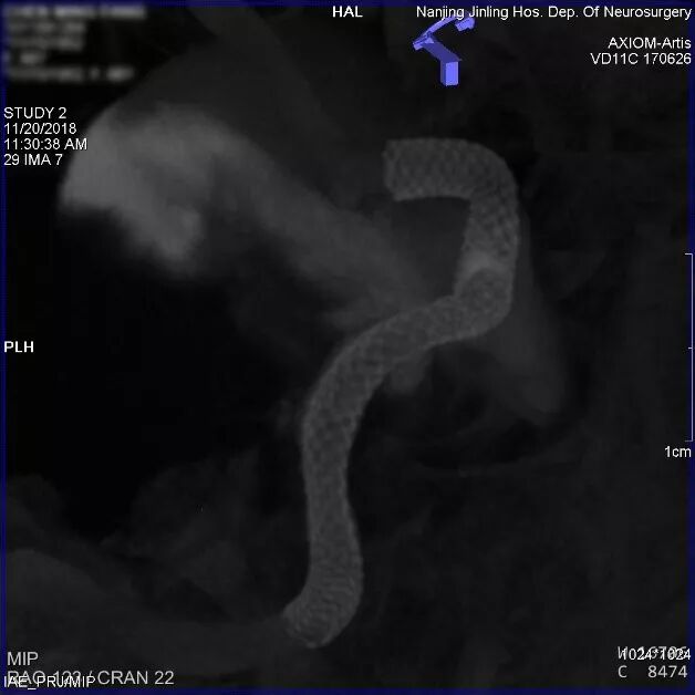 为什么要用到微导管张鑫教授：“球囊锚定微导管辅助到位”技术在Pipeline Flex治疗复杂动脉瘤手术中的应用_https://www.jmylbn.com_新闻资讯_第14张