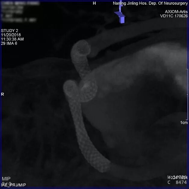 为什么要用到微导管张鑫教授：“球囊锚定微导管辅助到位”技术在Pipeline Flex治疗复杂动脉瘤手术中的应用_https://www.jmylbn.com_新闻资讯_第13张