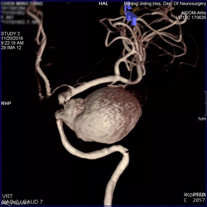为什么要用到微导管张鑫教授：“球囊锚定微导管辅助到位”技术在Pipeline Flex治疗复杂动脉瘤手术中的应用_https://www.jmylbn.com_新闻资讯_第1张