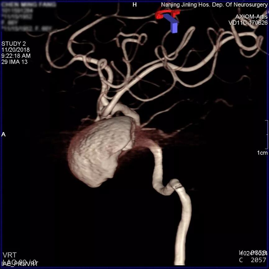 为什么要用到微导管张鑫教授：“球囊锚定微导管辅助到位”技术在Pipeline Flex治疗复杂动脉瘤手术中的应用_https://www.jmylbn.com_新闻资讯_第3张