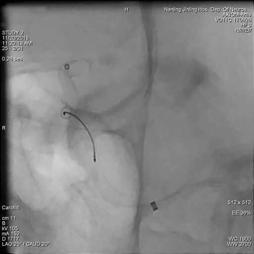 为什么要用到微导管张鑫教授：“球囊锚定微导管辅助到位”技术在Pipeline Flex治疗复杂动脉瘤手术中的应用_https://www.jmylbn.com_新闻资讯_第11张