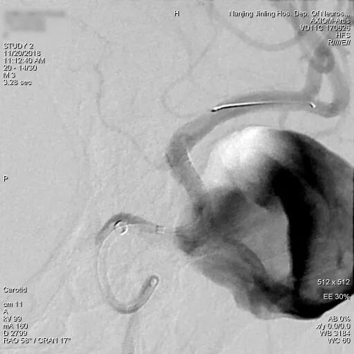 为什么要用到微导管张鑫教授：“球囊锚定微导管辅助到位”技术在Pipeline Flex治疗复杂动脉瘤手术中的应用_https://www.jmylbn.com_新闻资讯_第8张
