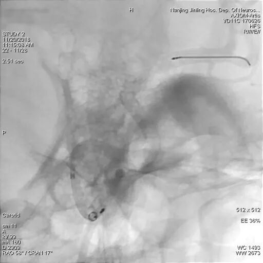 为什么要用到微导管张鑫教授：“球囊锚定微导管辅助到位”技术在Pipeline Flex治疗复杂动脉瘤手术中的应用_https://www.jmylbn.com_新闻资讯_第9张