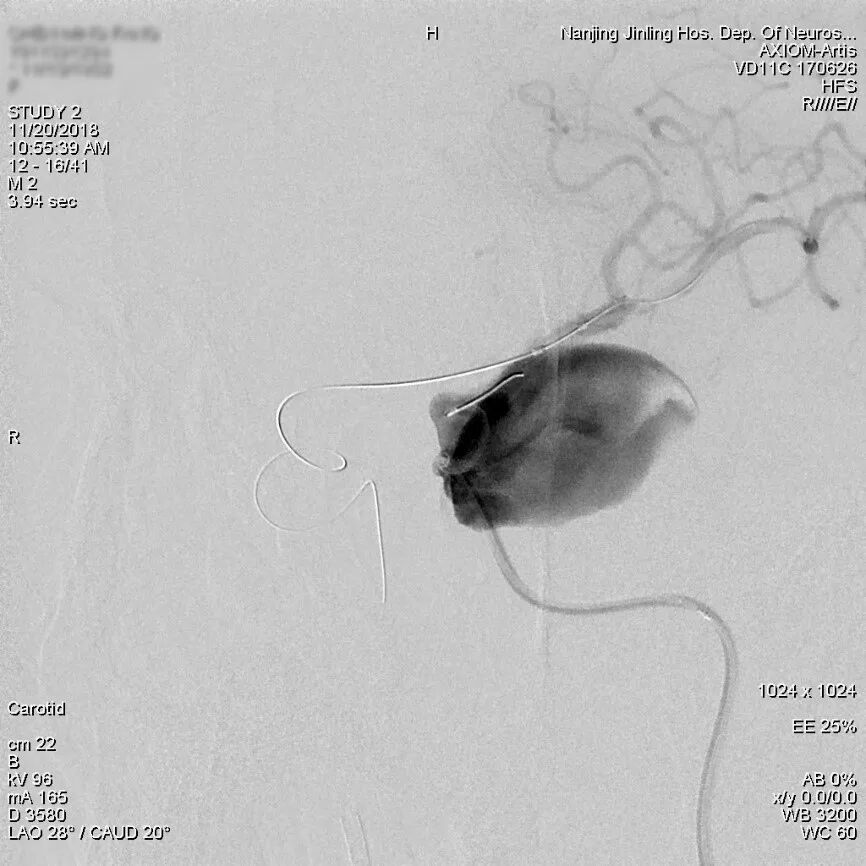 为什么要用到微导管张鑫教授：“球囊锚定微导管辅助到位”技术在Pipeline Flex治疗复杂动脉瘤手术中的应用_https://www.jmylbn.com_新闻资讯_第5张