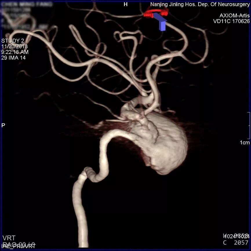 为什么要用到微导管张鑫教授：“球囊锚定微导管辅助到位”技术在Pipeline Flex治疗复杂动脉瘤手术中的应用_https://www.jmylbn.com_新闻资讯_第2张