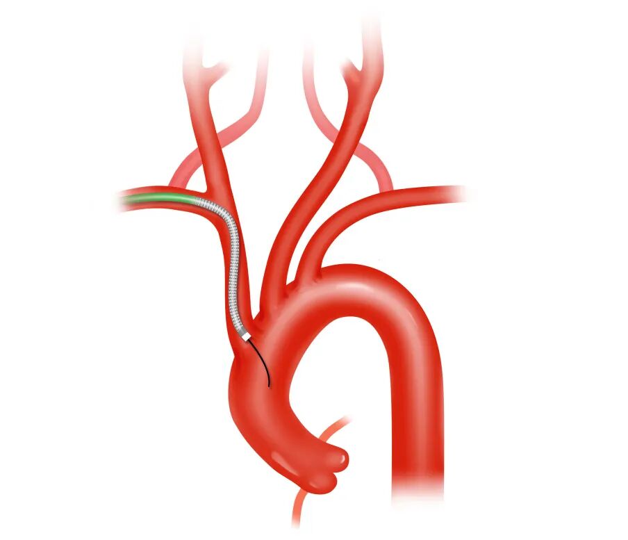 泥鳅导丝怎么用盘途问路，桡行而至丨ATTACH经桡中间导管成袢技术详解_https://www.jmylbn.com_新闻资讯_第8张