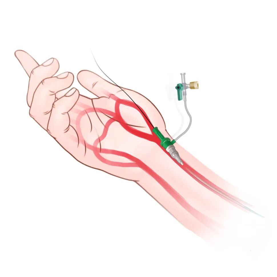 泥鳅导丝怎么用盘途问路，桡行而至丨ATTACH经桡中间导管成袢技术详解_https://www.jmylbn.com_新闻资讯_第5张