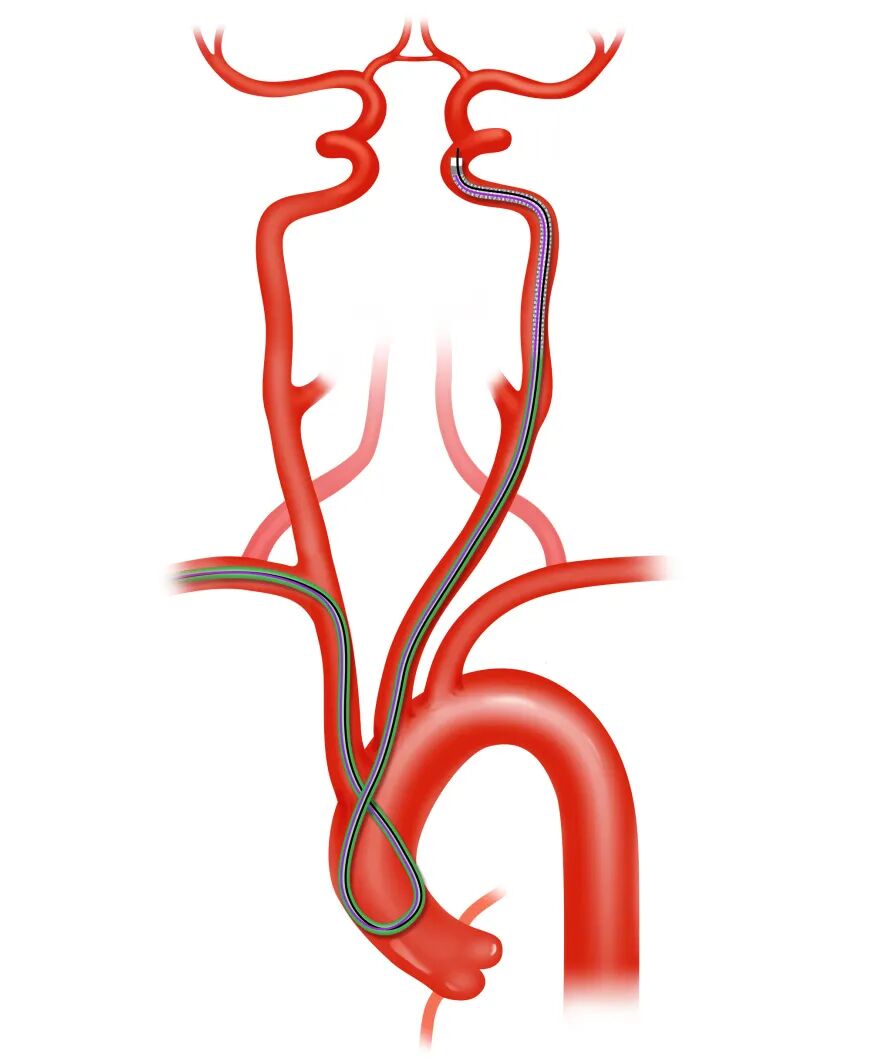 泥鳅导丝怎么用盘途问路，桡行而至丨ATTACH经桡中间导管成袢技术详解_https://www.jmylbn.com_新闻资讯_第20张