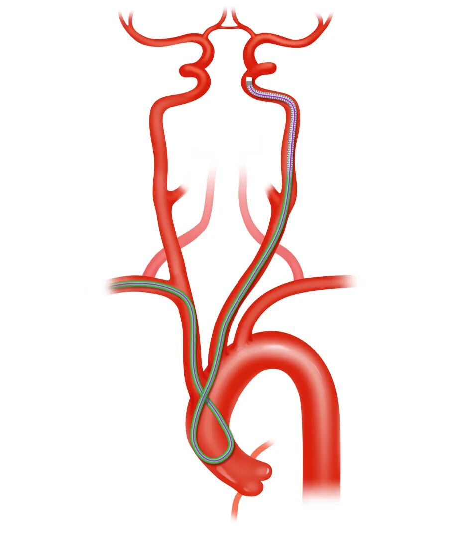 泥鳅导丝怎么用盘途问路，桡行而至丨ATTACH经桡中间导管成袢技术详解_https://www.jmylbn.com_新闻资讯_第21张