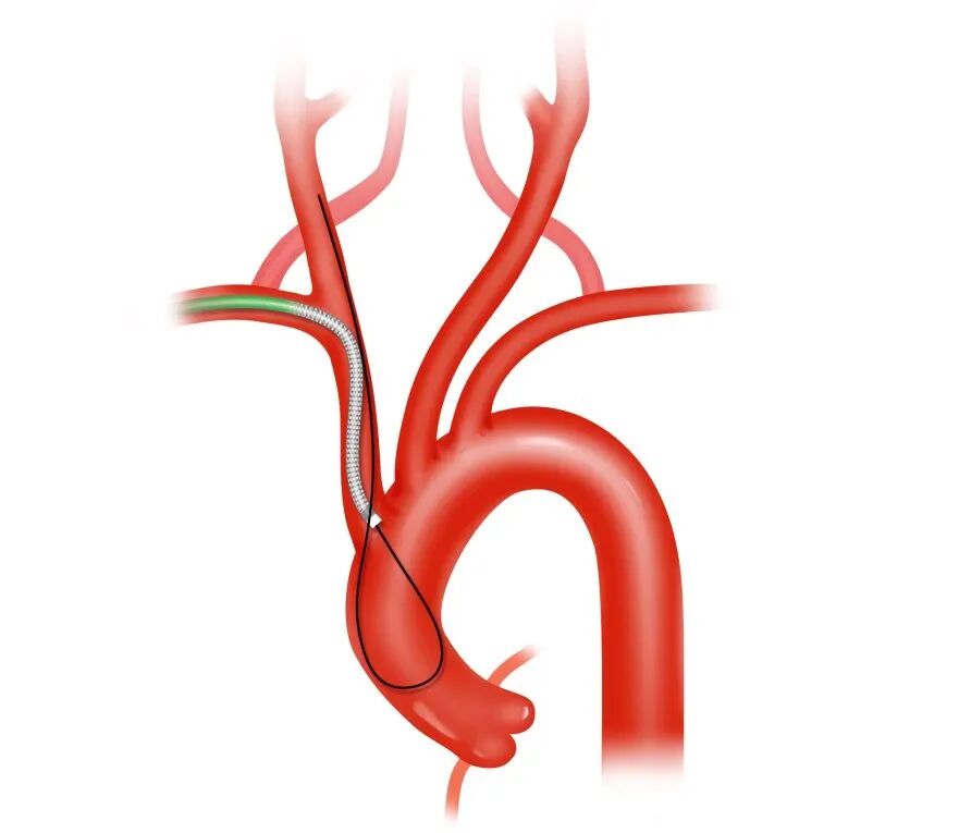 泥鳅导丝怎么用盘途问路，桡行而至丨ATTACH经桡中间导管成袢技术详解_https://www.jmylbn.com_新闻资讯_第10张
