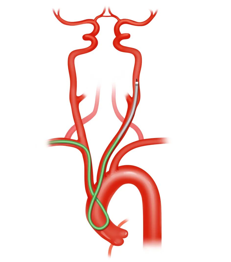 泥鳅导丝怎么用盘途问路，桡行而至丨ATTACH经桡中间导管成袢技术详解_https://www.jmylbn.com_新闻资讯_第18张