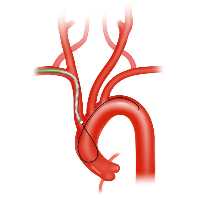 泥鳅导丝怎么用盘途问路，桡行而至丨ATTACH经桡中间导管成袢技术详解_https://www.jmylbn.com_新闻资讯_第14张