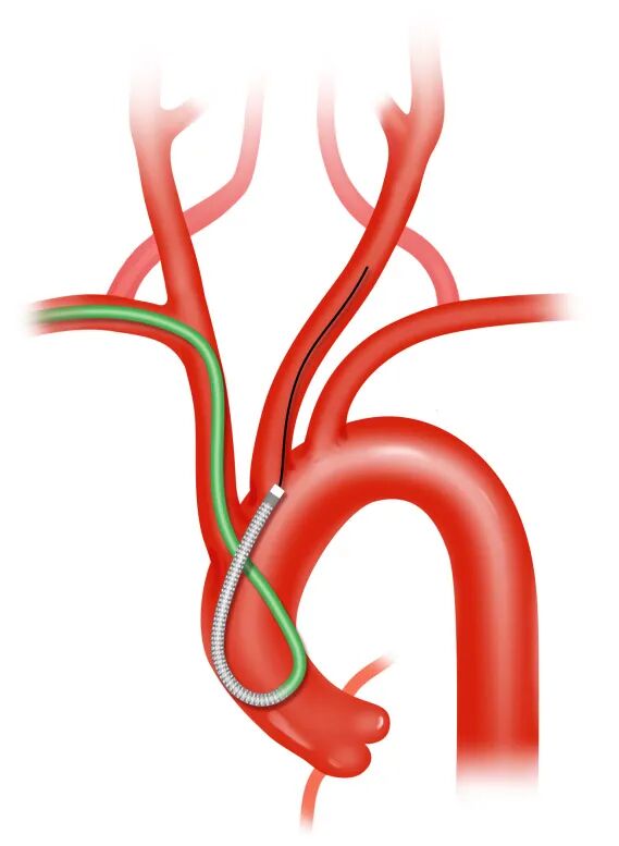 泥鳅导丝怎么用盘途问路，桡行而至丨ATTACH经桡中间导管成袢技术详解_https://www.jmylbn.com_新闻资讯_第17张