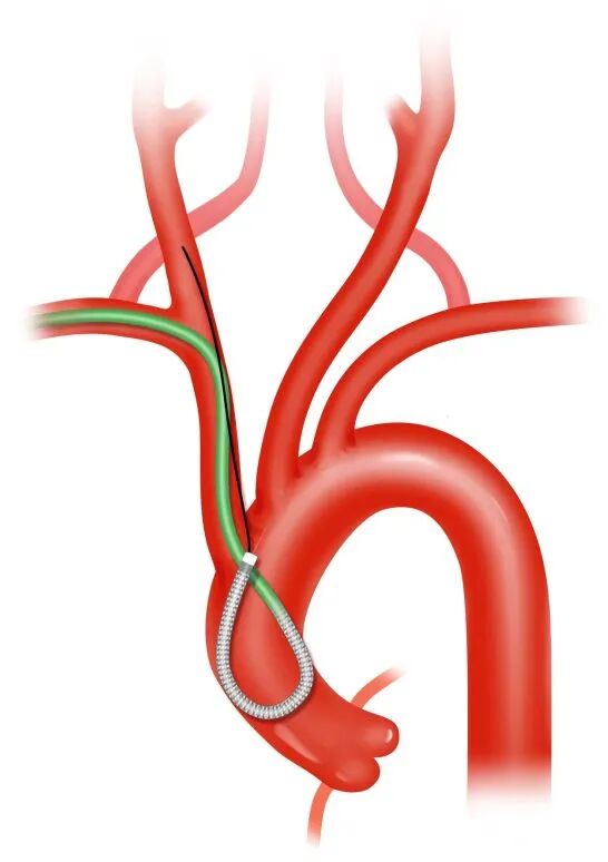 泥鳅导丝怎么用盘途问路，桡行而至丨ATTACH经桡中间导管成袢技术详解_https://www.jmylbn.com_新闻资讯_第11张