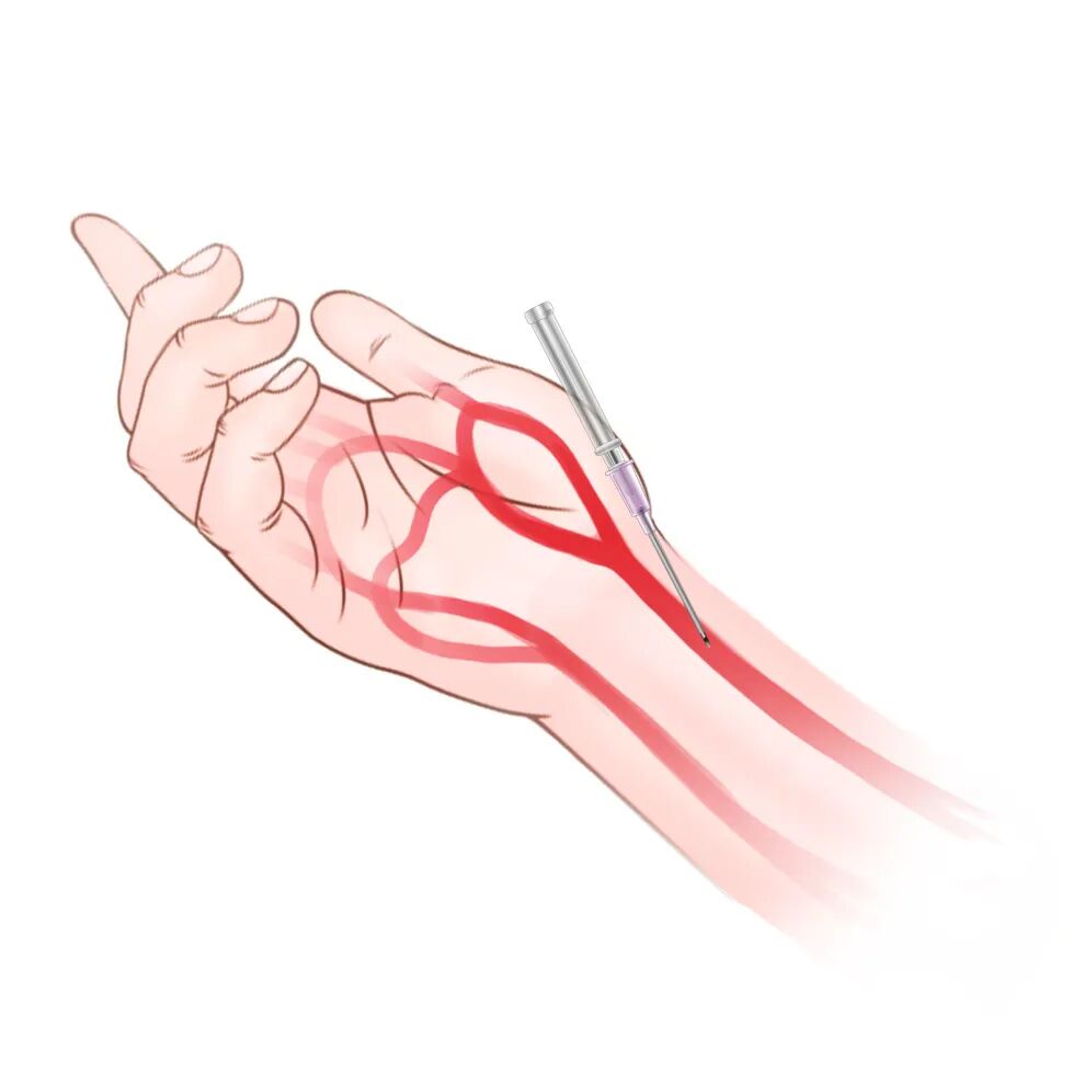 泥鳅导丝怎么用盘途问路，桡行而至丨ATTACH经桡中间导管成袢技术详解_https://www.jmylbn.com_新闻资讯_第4张
