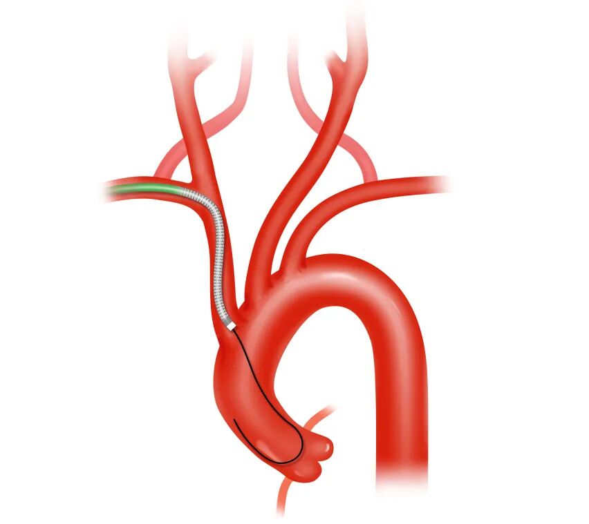 泥鳅导丝怎么用盘途问路，桡行而至丨ATTACH经桡中间导管成袢技术详解_https://www.jmylbn.com_新闻资讯_第9张